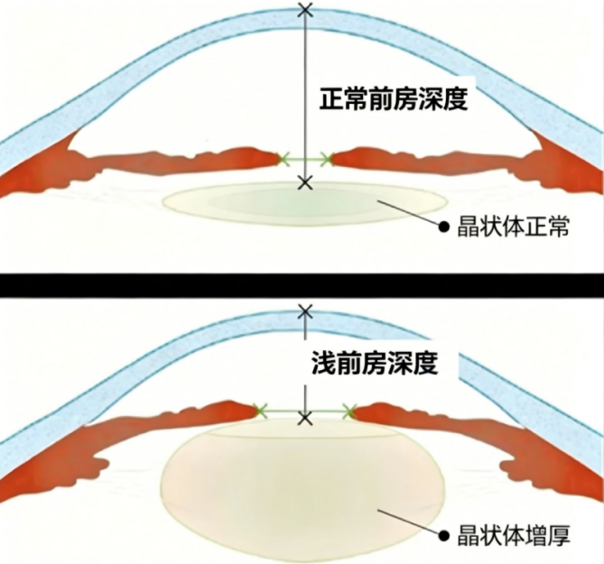 六旬阿姨白内障拖成急性青光眼 武汉普瑞眼科专家提醒尽早干预