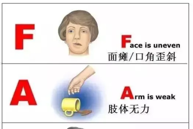眼前一黑、说不出话，几分钟就好？当心！这可能是身体在发出「小中风」警报