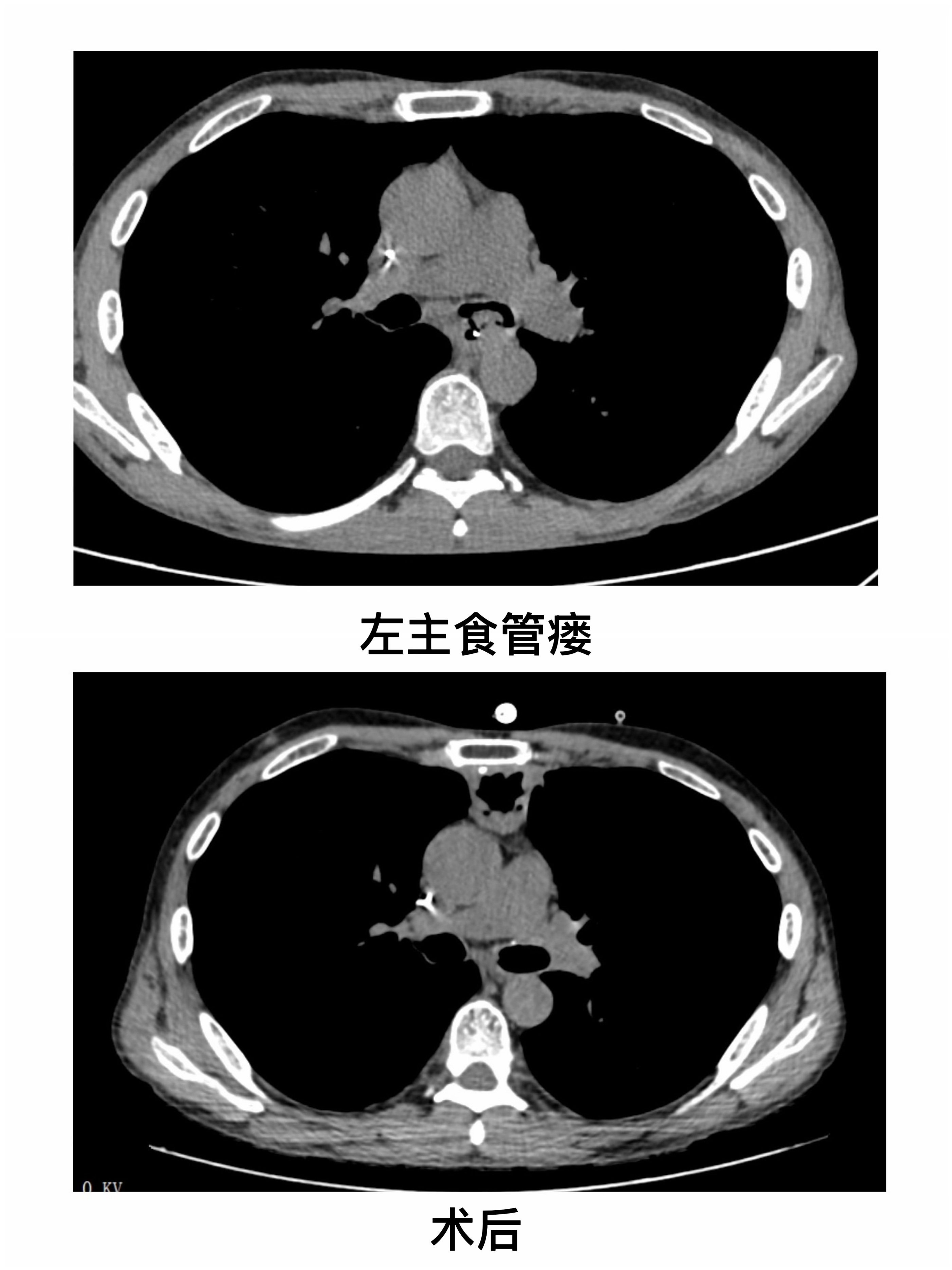 创新突破复杂食管气管瘘治疗「禁区」,武汉大学人民医院胸外科「独门绝活」吸引全国患者来汉求治