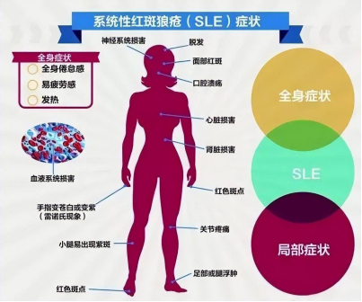 【别让「小皮疹」拖成「大麻烦」】我院救治一例红斑狼疮患者