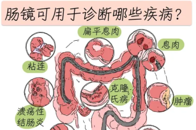 【专家讲堂】告别「清肠」烦恼，轻松迎接肠镜检查