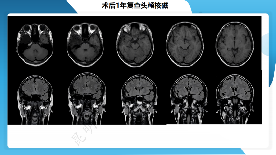 手术治疗脑膜血管瘤病致难治性癫痫一例