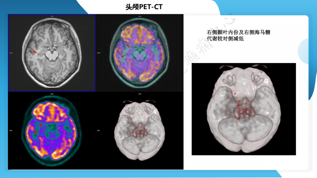 手术治疗脑膜血管瘤病致难治性癫痫一例