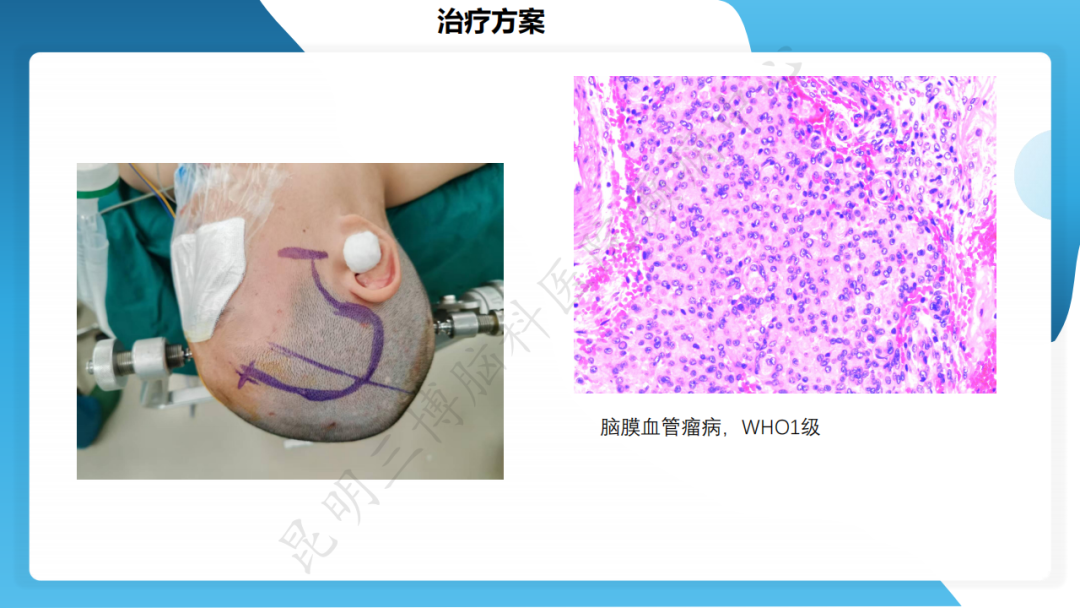 手术治疗脑膜血管瘤病致难治性癫痫一例