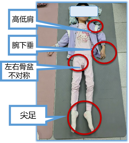 从摇晃不稳到独立行走！儿童康复，不只在医院里
