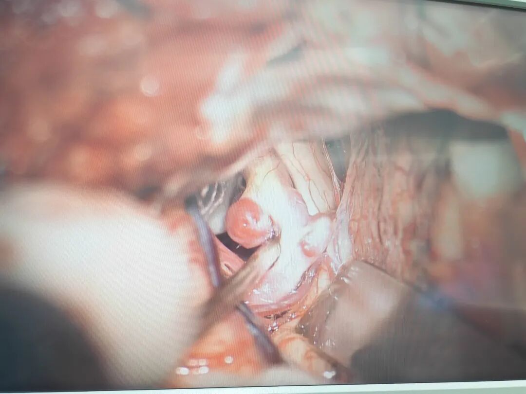 病房巧结缘！邻床姐妹同遇脑部「炸弹」，微创小骨窗开颅精准拆弹