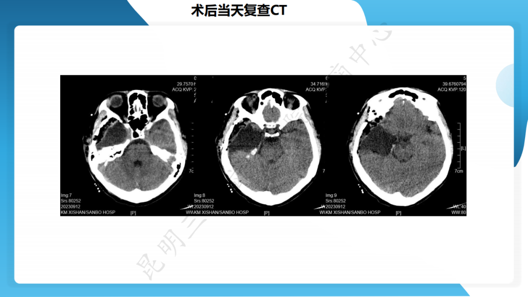 手术治疗脑膜血管瘤病致难治性癫痫一例