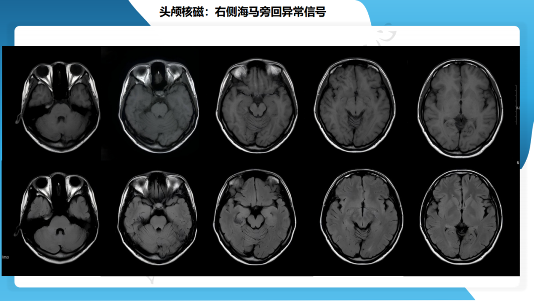 手术治疗脑膜血管瘤病致难治性癫痫一例