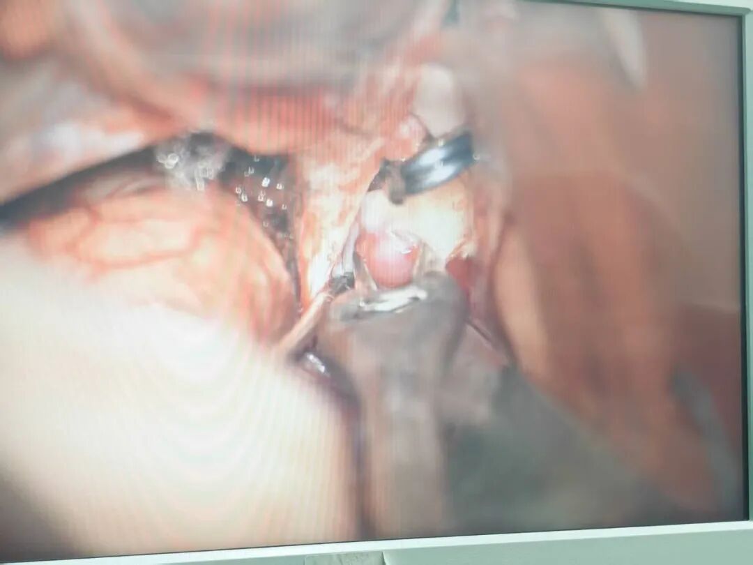 病房巧结缘！邻床姐妹同遇脑部「炸弹」，微创小骨窗开颅精准拆弹