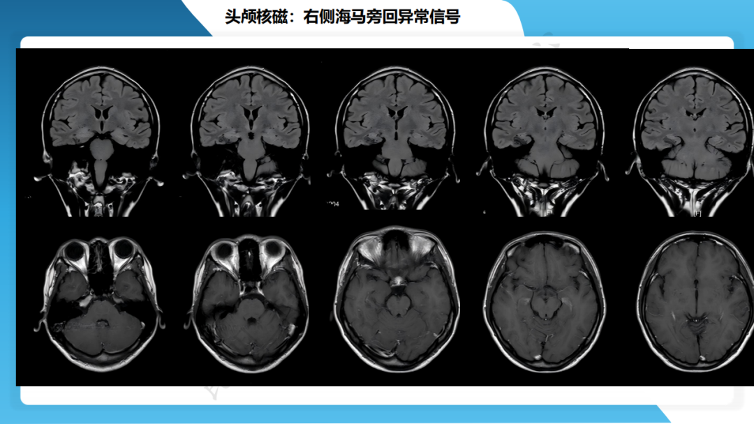 手术治疗脑膜血管瘤病致难治性癫痫一例