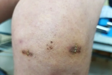 雨天送餐遇车祸，关节镜微创助力，外卖小哥重返岗！