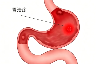 急症急救 + 慢病同治 国文医院消化内科成功救治上消化道出血患者