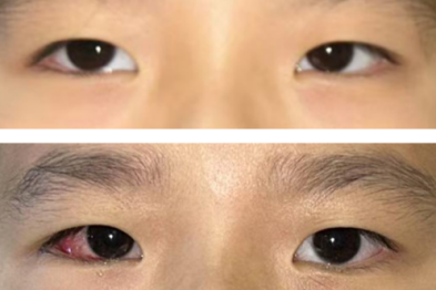 7 岁女孩外斜视，斜视矫正术守护儿童视功能发育