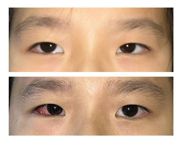 7 岁女孩外斜视,斜视矫正术守护儿童视功能发育