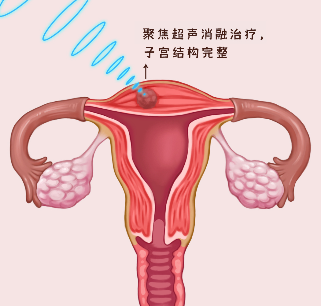 孕期合并子宫肌瘤如何护理?产后无创治疗的最佳时机