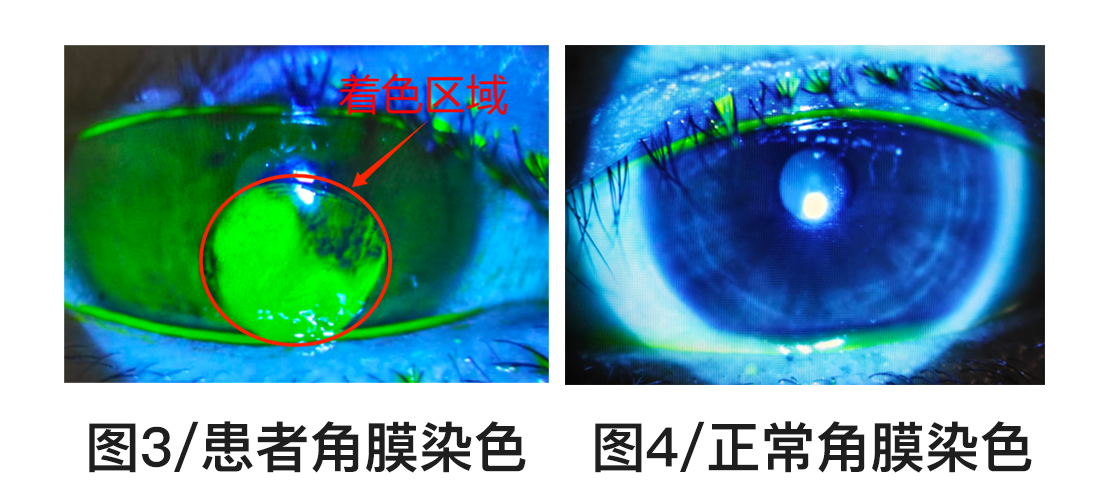 眼睛刺痛到睁不开?警惕角膜上皮脱落这个「隐形杀手」