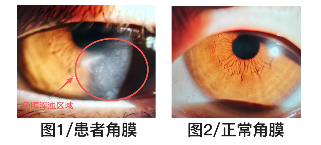 眼睛刺痛到睁不开?警惕角膜上皮脱落这个「隐形杀手」