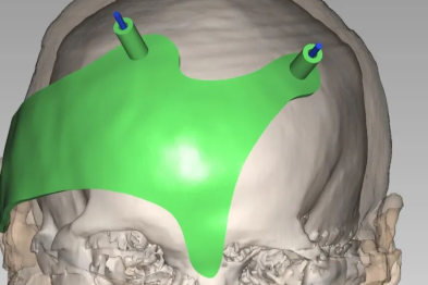 3D 打印精准导航  |  遂川共享中心运营部助力院脑外科成功完成丘脑出血微创辅助手术