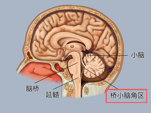 7 cm 巨大脑瘤!脑干受压超 2/3!14 岁孩子听力异常竟濒临生死绝境