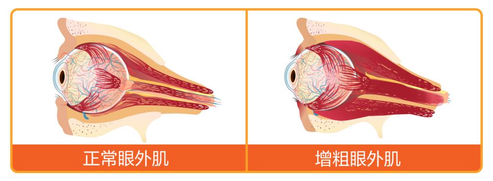 甲亢甲减致眼突,专病专治更靠谱——爱尔眼科 22 城 33 家甲状腺眼病专病门诊,开启精准诊疗时代!