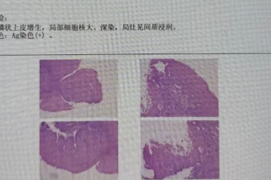 【高尚病例】58 岁男吞咽困难，被查出食管鳞癌