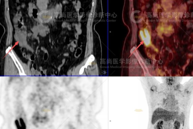 【高尚病例】因颈部肿物就诊，发现结肠印戒细胞癌