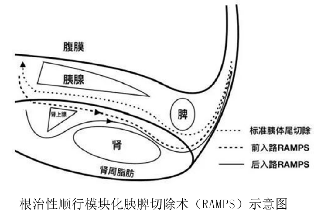 亮剑「癌中之王」!浙大一院专家凌琪助力南大二附院完成多例高难度胰腺癌微创手术