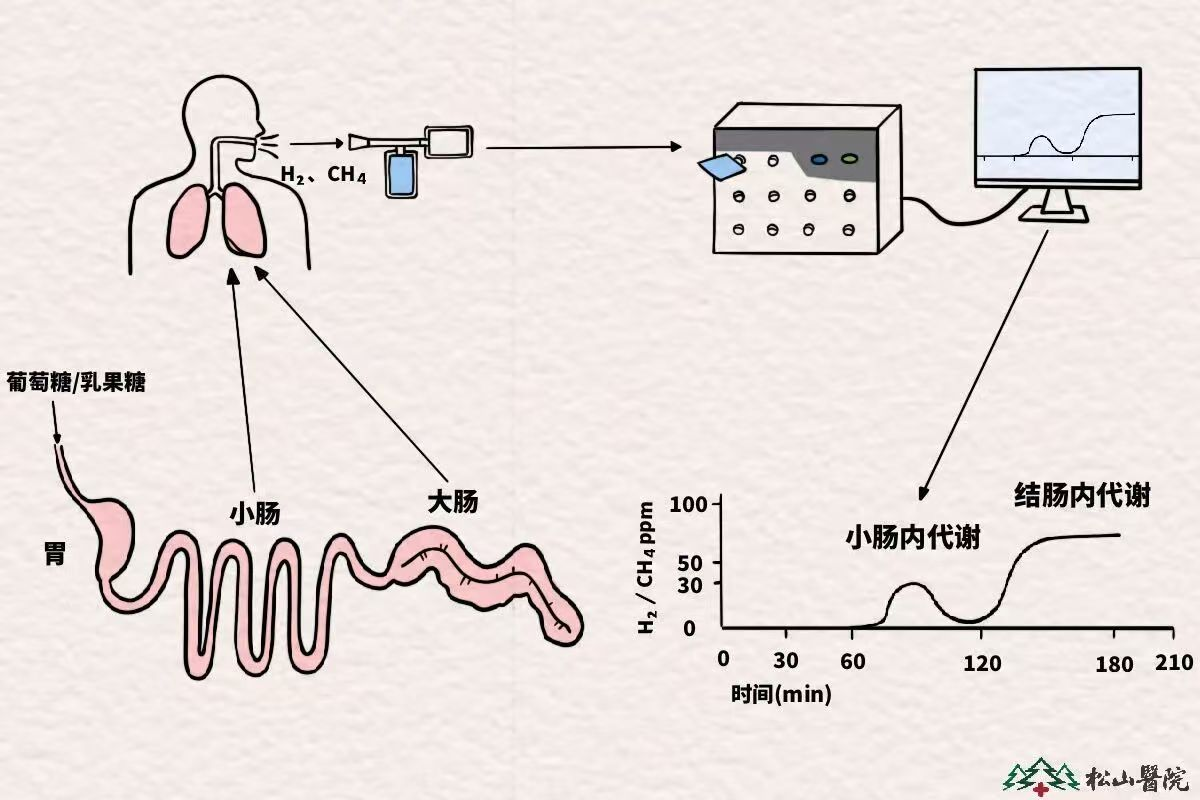 肠道健康日|别忽视腹胀、排气多、消化不良 一文读懂小肠细菌过度生长