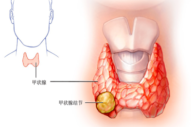 查出甲状腺结节＝得了癌症？真相在这里！