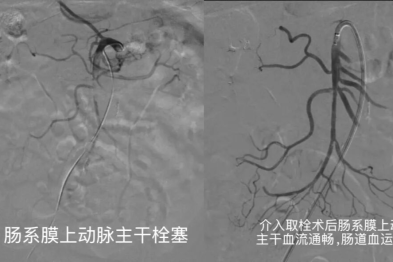 生死竞速抢生机！两院联动成功救治高致死率「肠道卒中」患者
