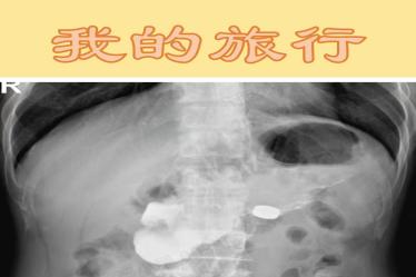 以磁为刃，向险而行——西安交大一附院磁外科团队开创经口吞磁无创治疗消化道狭窄