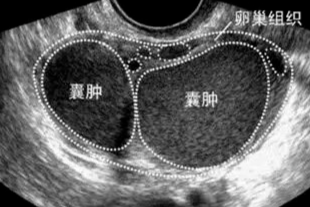 【超声病例】子宫卵巢巧克力囊肿，你了解吗？