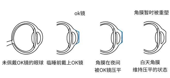 OK 镜、RGP、离焦软镜、巩膜镜大 PK!孩子近视该选哪种?