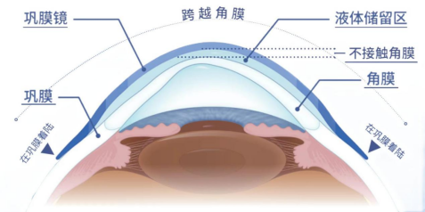 OK 镜、RGP、离焦软镜、巩膜镜大 PK!孩子近视该选哪种?