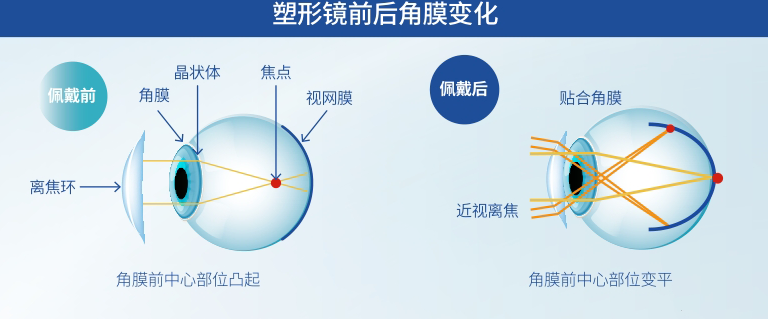 OK 镜、RGP、离焦软镜、巩膜镜大 PK!孩子近视该选哪种?
