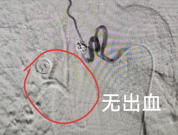 咯血 250 毫升险休克,介入科「血管内封堵」击退大咯血
