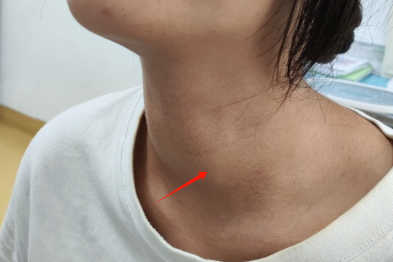【守护健康】信了「懒癌」说法，她把甲状腺癌从低危拖成了中危……