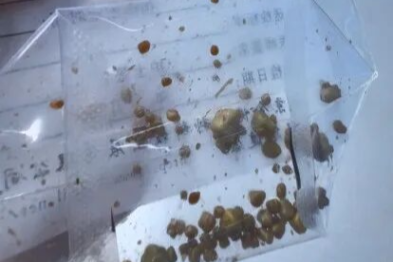 胆囊被结石填满、胰腺炎反复发作——国文医院为 90 岁患者成功实施胆道探查取石术