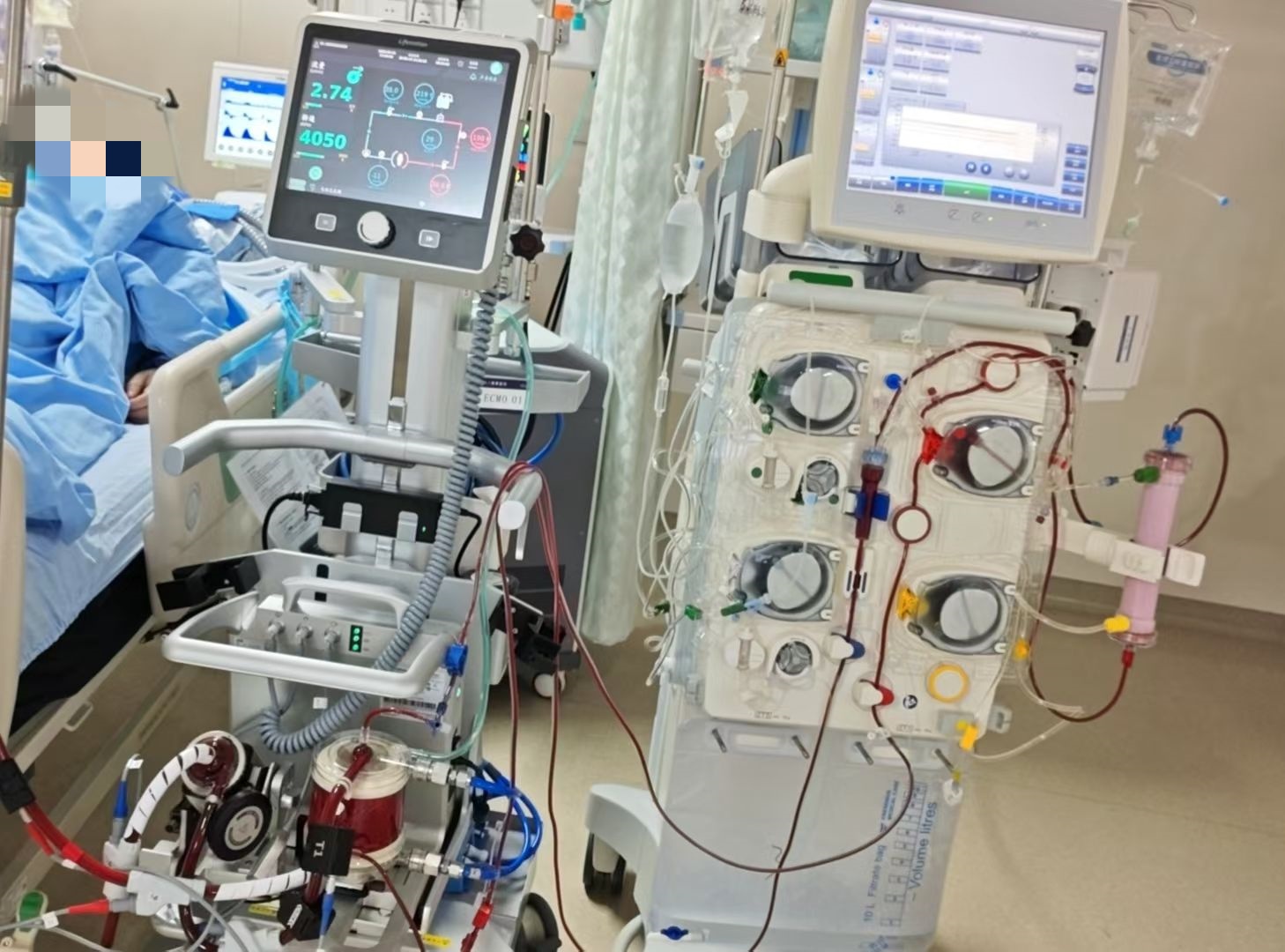 ECMO 守护「生命防线」!多科室协力合作,为心脏骤停患者重启「心」生