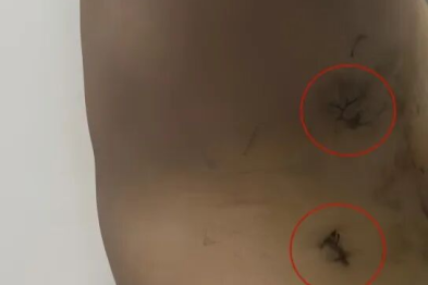 做心脏手术，还能不开胸？！这群医生，常规开展「美容」心脏术式～