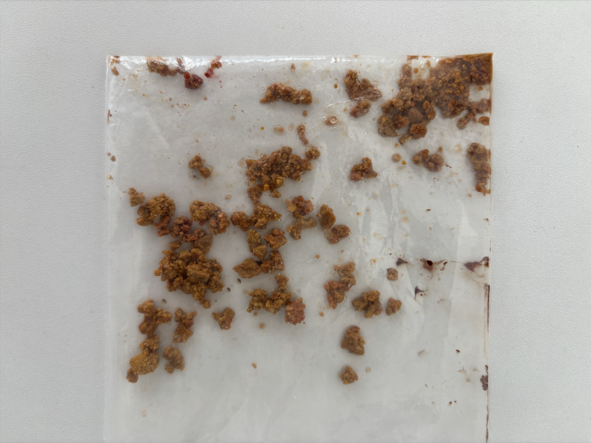 排尿像「挤牙膏」还带血?国文医院微创碎石,让 60 岁大叔重获健康!