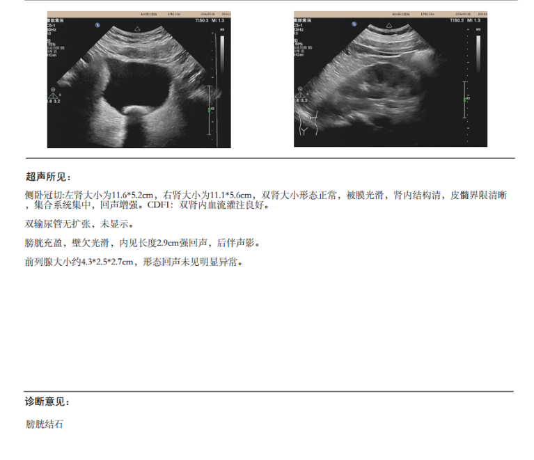 排尿像「挤牙膏」还带血?国文医院微创碎石,让 60 岁大叔重获健康!