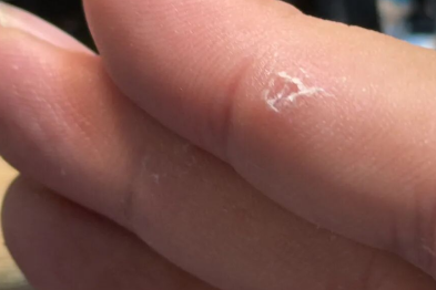 夏天手上长小水泡痒到抓心？别乱挠！这不是脚气，是汗疱疹