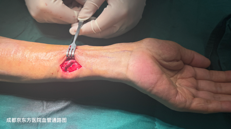 高龄复杂肾病患者自体内瘘成功开通,告别透析导管有望!