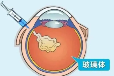 眼科医生许大玲科普：眼睛里也能打针？带您了解玻璃体腔注药术
