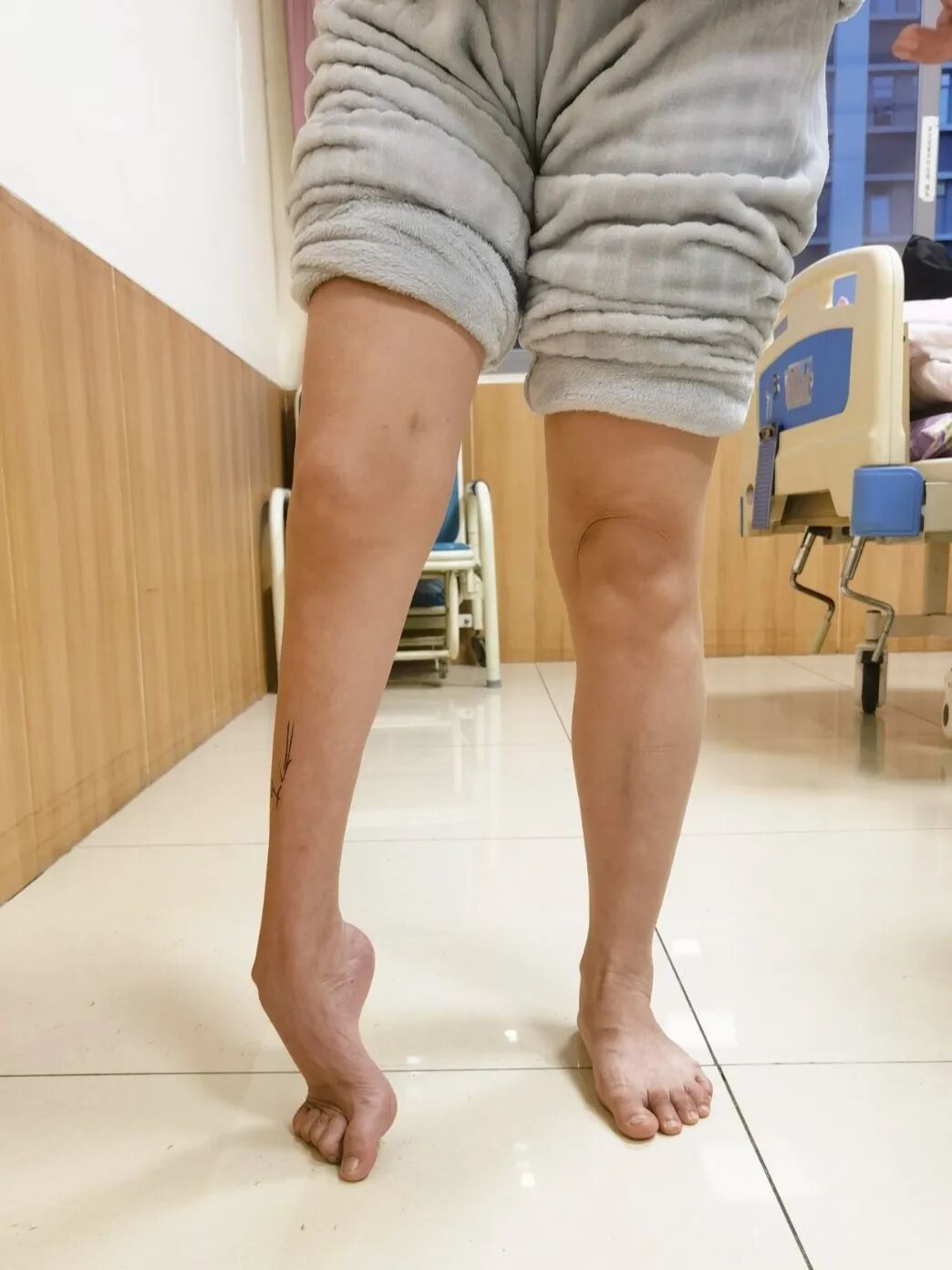 从跛行度日到稳稳行走!漳州第三医院攻克二十年难治性马蹄足畸形