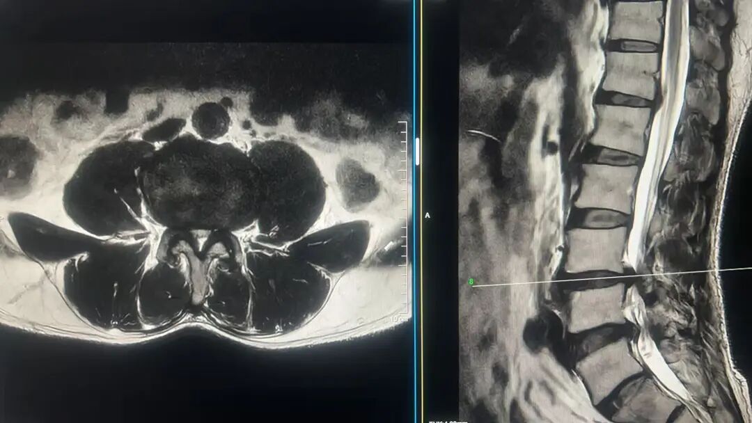 腰痛腿麻步履维艰！多术式联合高难手术助力复杂腰椎病变患者康复