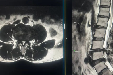 腰痛腿麻步履维艰！多术式联合高难手术助力复杂腰椎病变患者康复