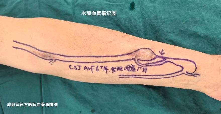 无症状不等于零风险!成都京东方医院通路团队精准评估,微创复通透析患者陈旧内瘘慢性闭塞