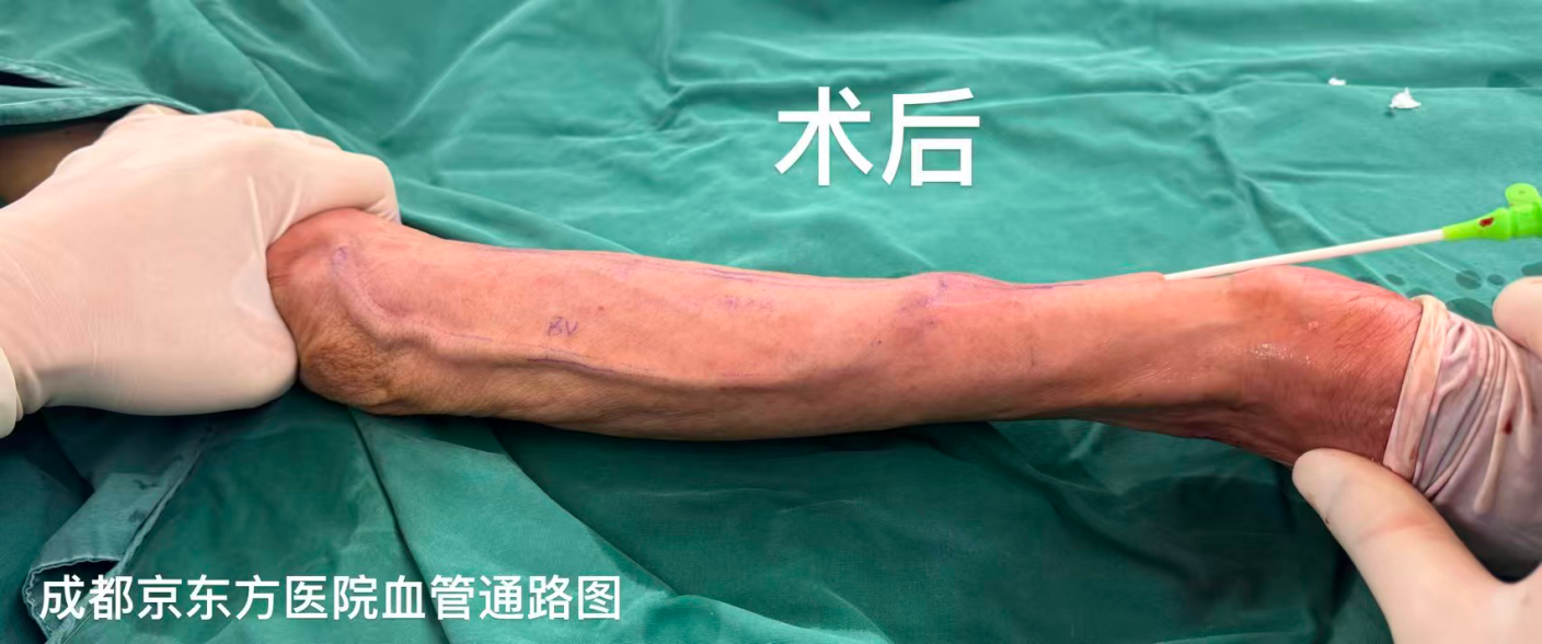 高龄复杂肾病患者自体内瘘成功开通,告别透析导管有望!